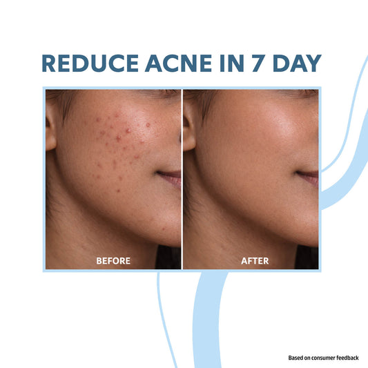 2-in-1 Acne Control + Boost Glow Facewash
